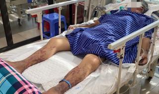 Hôn mê sâu, nguy kịch sau 2 ngày ăn tiết canh
