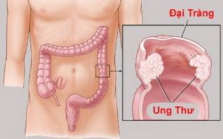 Chàng trai 24 tuổi bị táo bón cả tháng, đi khám phát hiện sự thật đau lòng