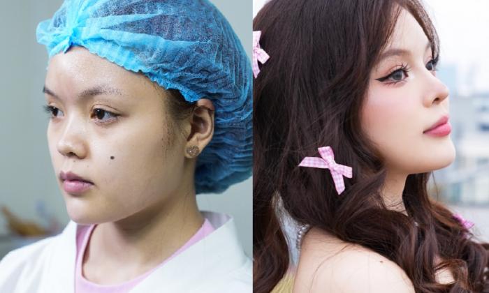 Review nâng mũi cấu trúc: Kết quả thực tế từ khách hàng của Bác sĩ Nick Dương