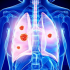 12 dấu hiệu cảnh báo ung thư phổi